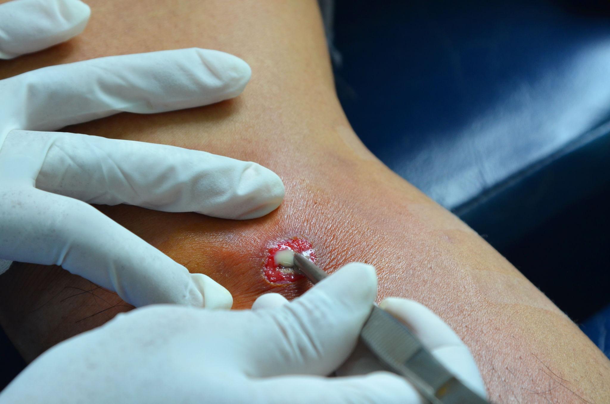 Abscess assessment and minor procedure service at Klinik Dr Care